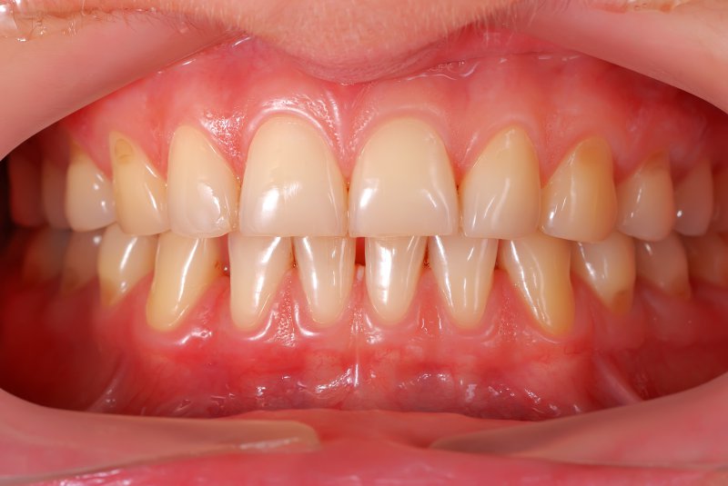 Gum Therapy
