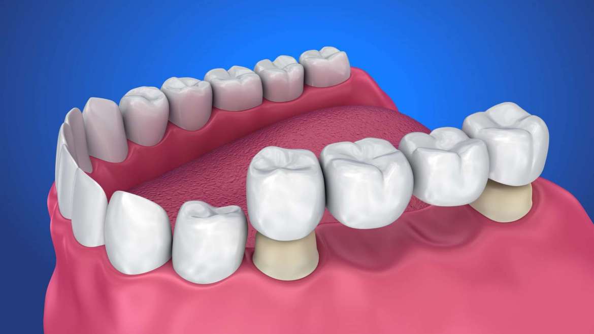 Dental Bridge